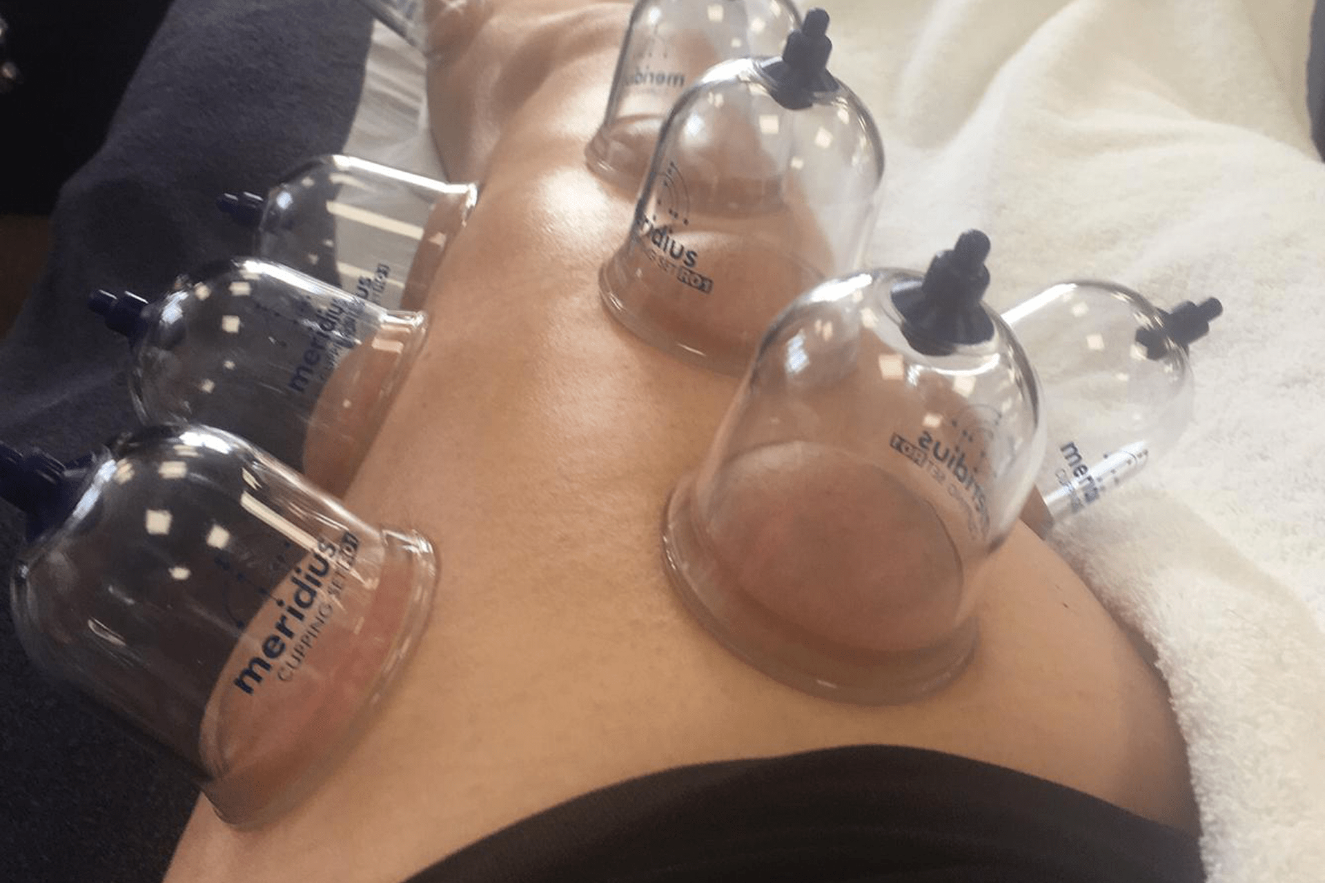 Dry Cupping Chester UK