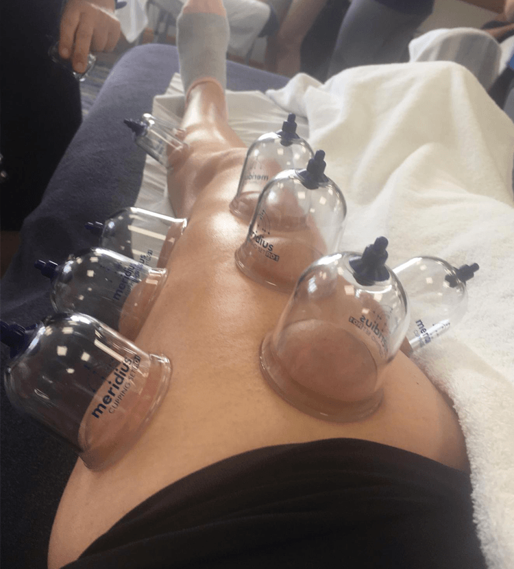 Dry Cupping Chester UK