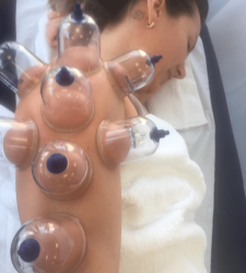 Dry Cupping Chester UK